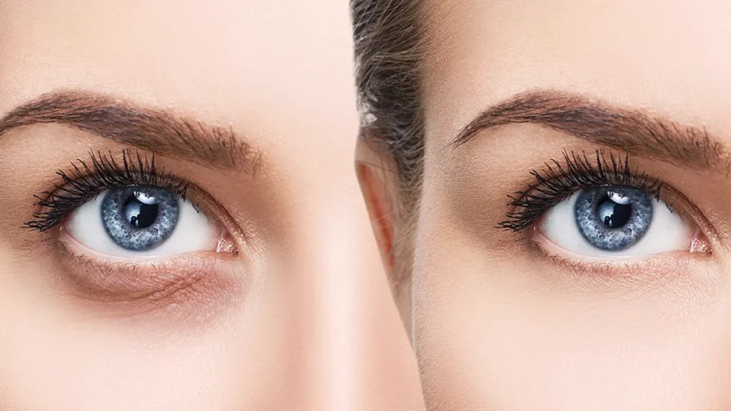 Ways to Improve the Look of Your Undereye
